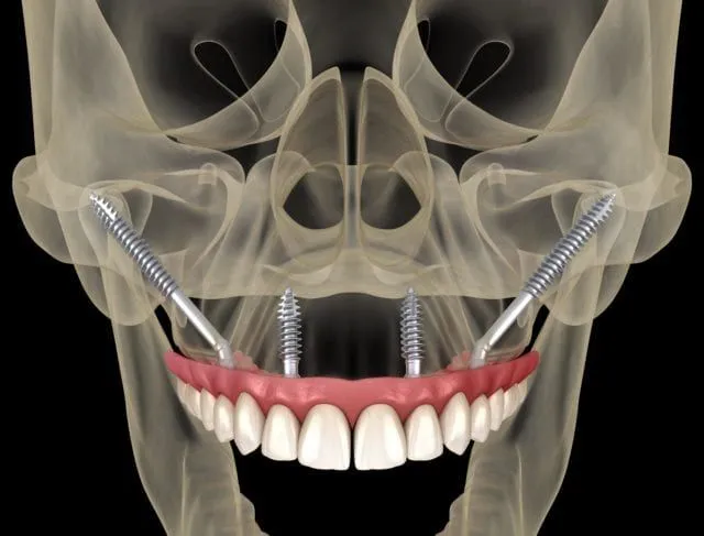 Zygomatic Implants