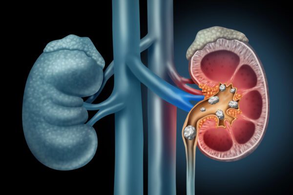Can Ozempic Cause Kidney Stones?